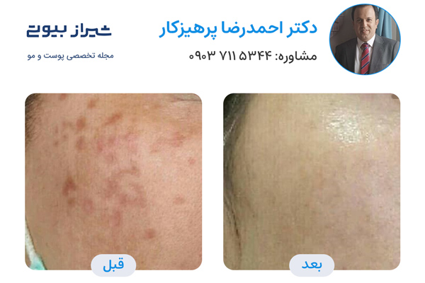 لیزر کیوسوییچ در شیراز - دکتر احمدرضا پرهیزکار