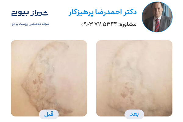لیزر کیوسوییچ در شیراز - دکتر احمدرضا پرهیزکار