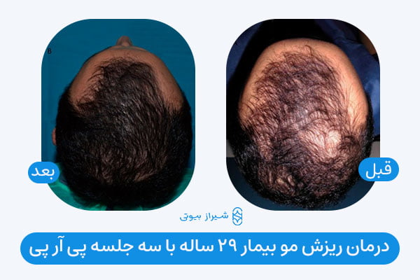 قبل و بعد درمان ریزش مو فرد 29 ساله با سه جلسه PRP مو