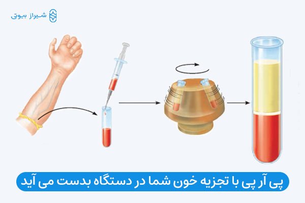 مراحل تجزیه خون و بدست آوردن پی آر پی مو