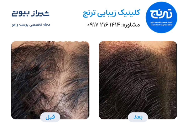 فیلر مو در شیراز - کلینیک ترنج