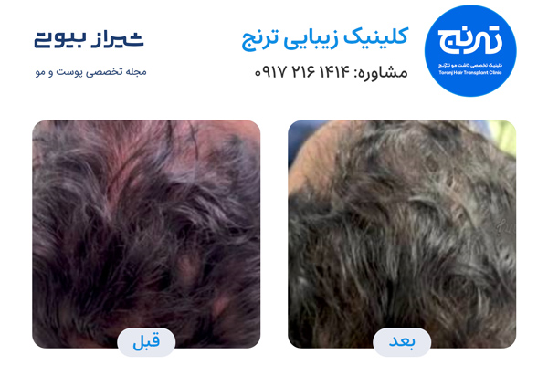 فیلر مو در شیراز - کلینیک ترنج