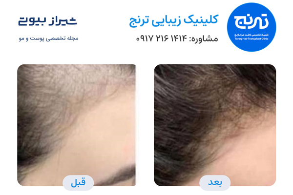 فیلر مو در شیراز - کلینیک ترنج