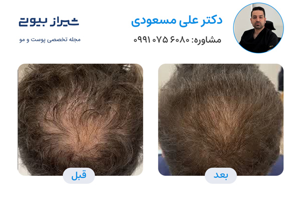 تزریق هیر فیلر در شیراز  - دکتر علی مسعودی
