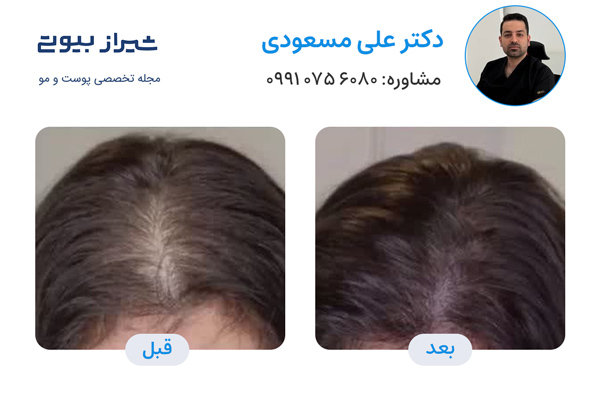 تزریق هیر فیلر در شیراز  - دکتر علی مسعودی