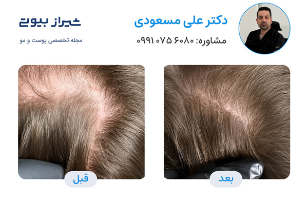 تزریق هیر فیلر در شیراز  - دکتر علی مسعودی