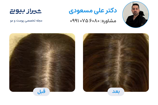 تزریق هیر فیلر در شیراز  - دکتر علی مسعودی