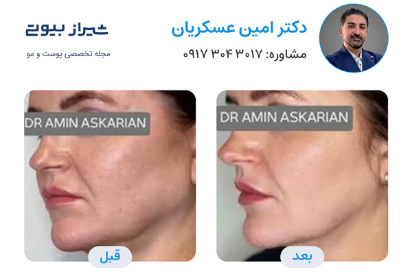 لیزر کک و مک در شیراز - دکتر امین عسکریان