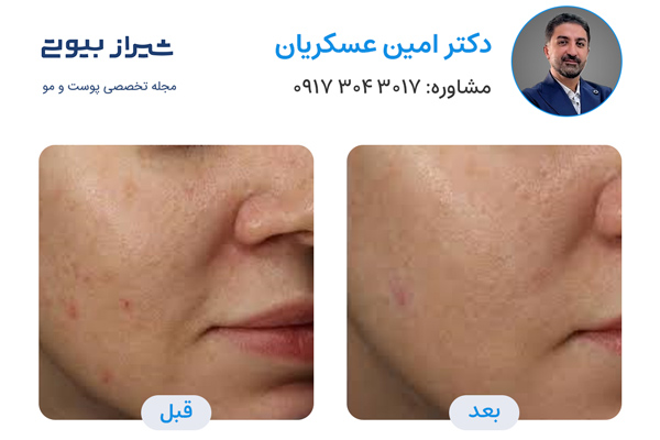 لیزر کک و مک در شیراز - دکتر امین عسکریان
