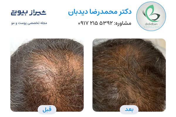 فیلر مو در شیراز - دکتر محمدرضا دیدبان