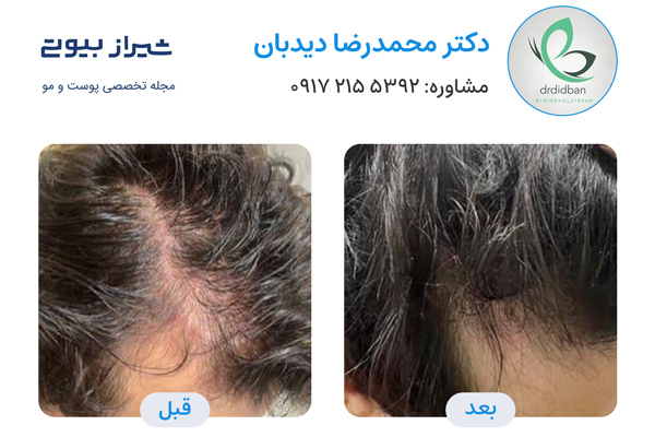 فیلر مو در شیراز - دکتر محمدرضا دیدبان