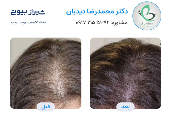 فیلر مو در شیراز - دکتر محمدرضا دیدبان
