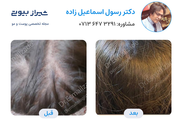 پی آر پی مو در شیراز - دکتر رسول اسماعیل زاده