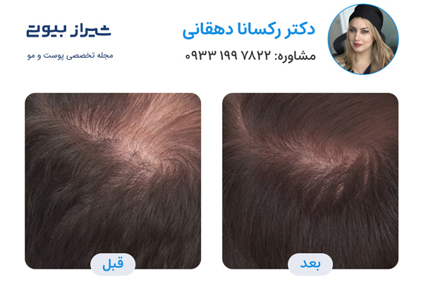 پی آر پی مو در شیراز - دکتر رکسانا دهقانی