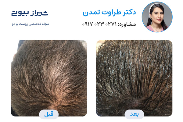 مزوتراپی مو در شیراز - دکتر طراوت تمدن