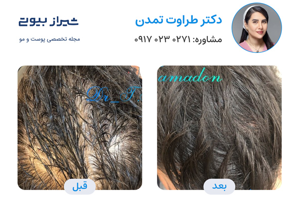 مزوتراپی مو در شیراز - دکتر طراوت تمدن