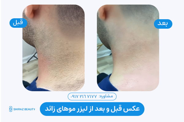 Laser hair removal before and after c