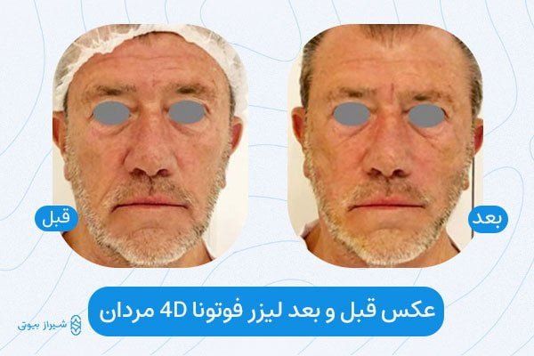 Fotona Non Invasive Facial Rejuvenation for Men