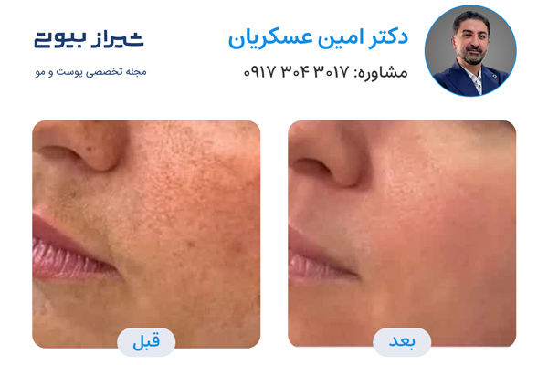 لیزر فوتونا در شیراز - دکتر امین عسکریان