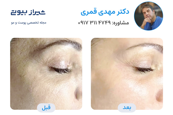 مزوتراپی صورت در شیراز - دکتر مهدی قمری