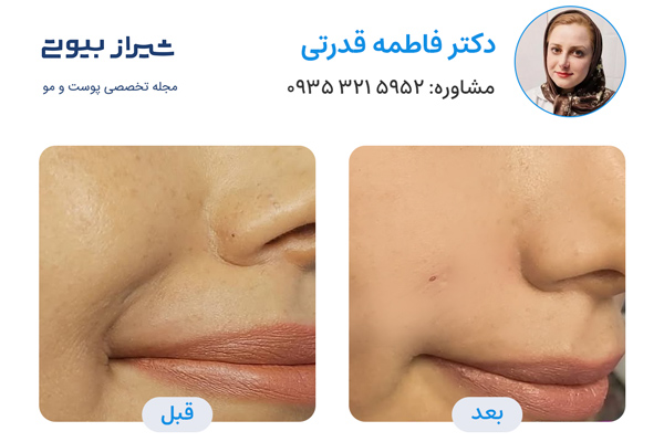 بهترین دکتر مزوتراپی صورت در شیراز - دکتر فاطمه قدرتی