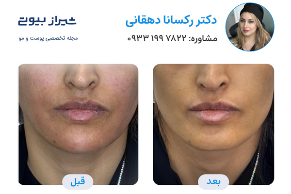 مزوتراپی صورت در شیراز - دکتر رکسانا دهقانی