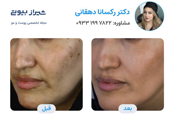 مزوتراپی صورت در شیراز - دکتر رکسانا دهقانی