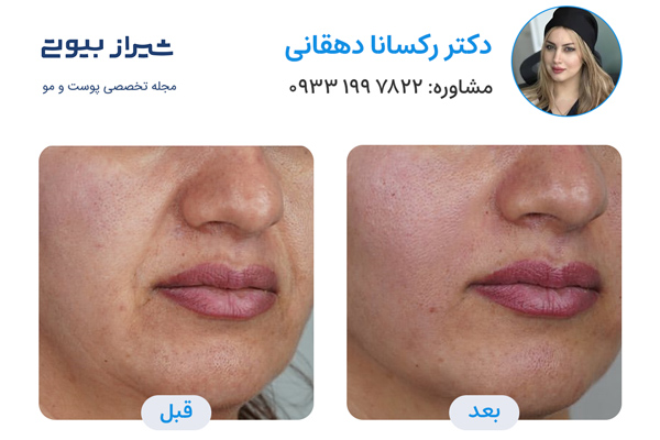 مزوتراپی صورت در شیراز - دکتر رکسانا دهقانی