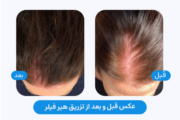 عکس قبل و بعد تزریق هیر فیلر