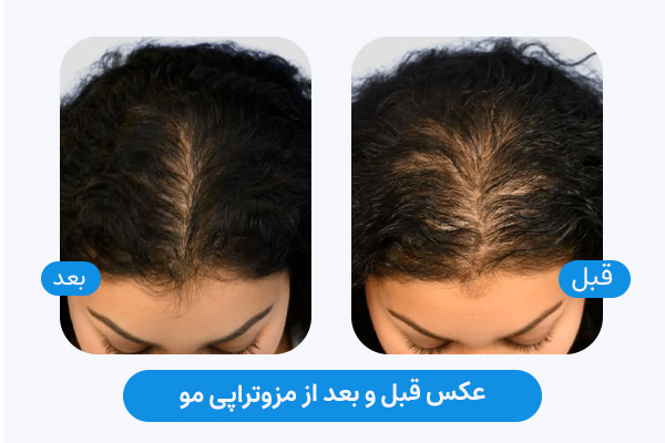عکس قبل و بعد مزوتراپی مو