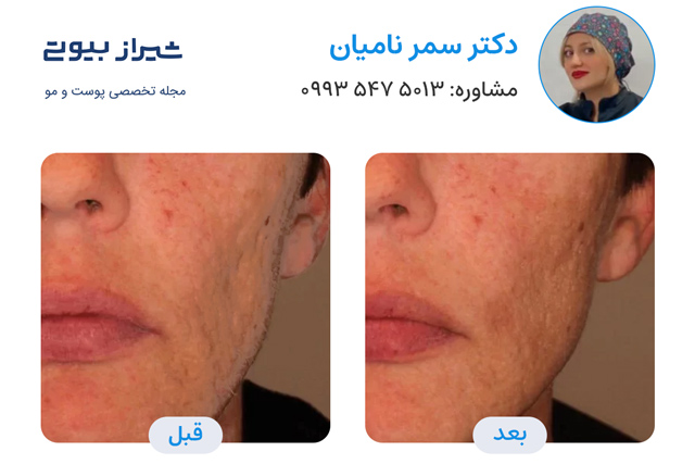 تصویر قبل و بعد سابسیژن در شیراز دکتر سمر نامیان