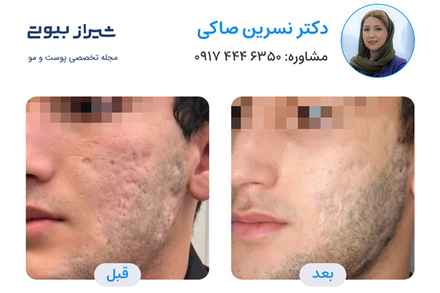 تصویر قبل و بعد سابسیژن در شیراز دکتر نسرین صاکی