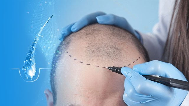 کاشت مو به روش سلولهای بنیادی