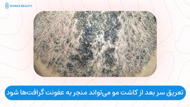 تعریق سر بعد از کاشت مو می‌تواند منجر به عفونت گرافت‌ها شود
