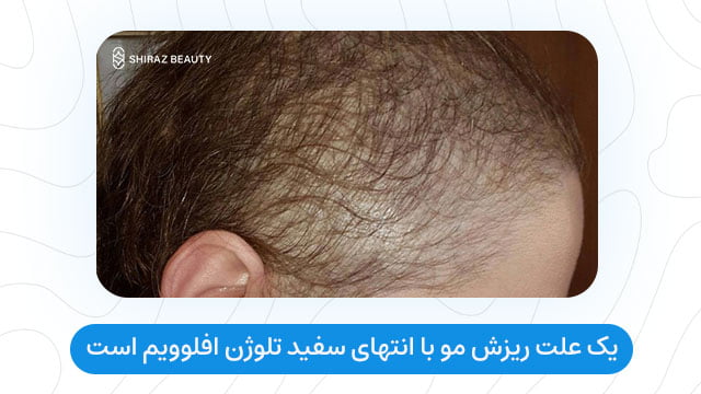 یک علت ریزش مو با انتهای سفید تلوژن افلوویم است