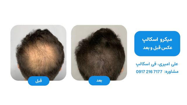 عکس قبل و بعد اسکالپ موی سر