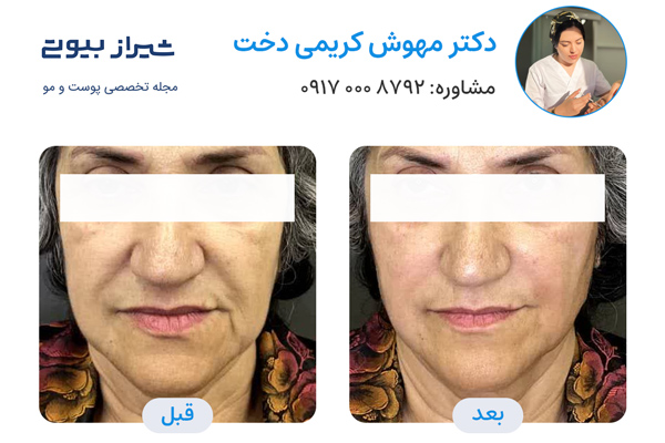 نمونه کار و عکس قبل و بعد لیفت با نخ در شیراز - دکتر مهوش کریمی دخت