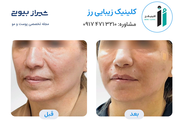 لیفت نخ در شیراز - کلینیک رز