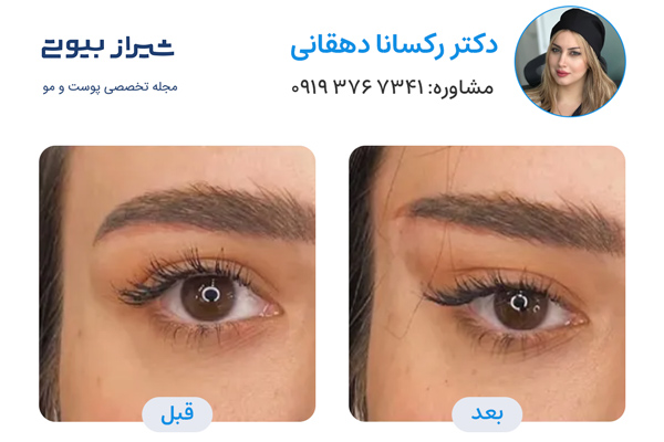 لیفت نخ در شیراز - دکتر رکسانا دهقانی