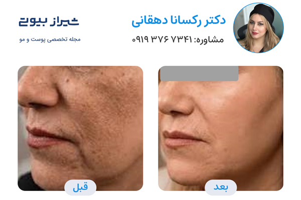 لیفت نخ در شیراز - دکتر رکسانا دهقانی
