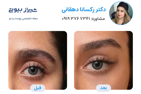 لیفت نخ در شیراز - دکتر رکسانا دهقانی