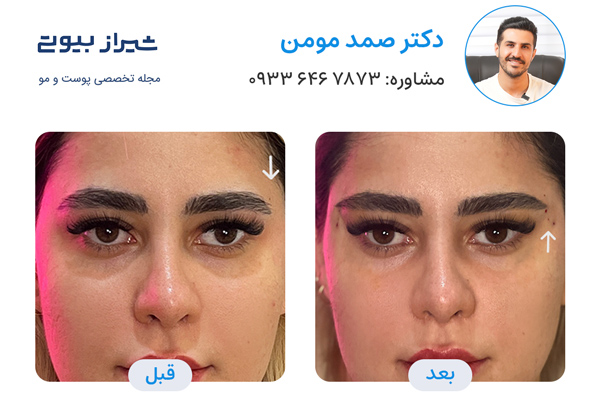 لیفت صورت با نخ در شیراز - دکتر صمد مومن