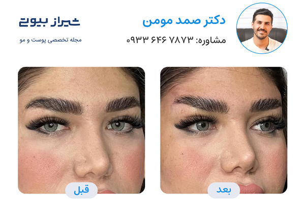 لیفت صورت با نخ در شیراز - دکتر صمد مومن