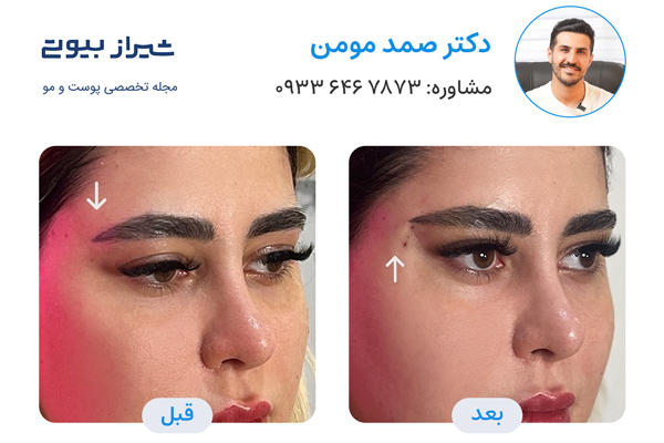 لیفت صورت با نخ در شیراز - دکتر صمد مومن