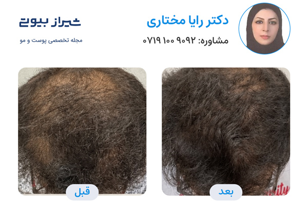 مزوتراپی مو در شیراز - دکتر رایا مختاری
