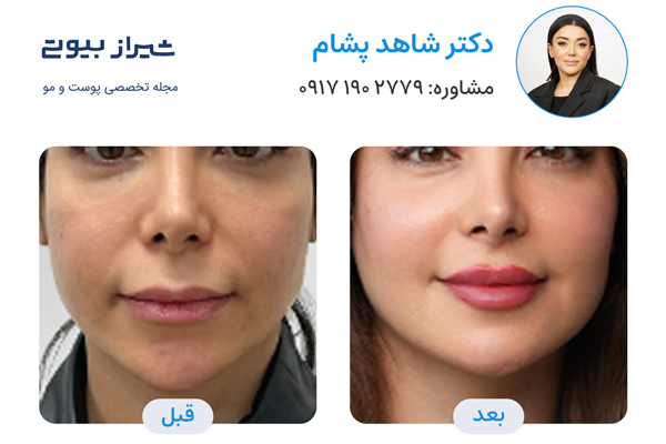 لیفت نخ در شیراز - دکتر شاهد پشام