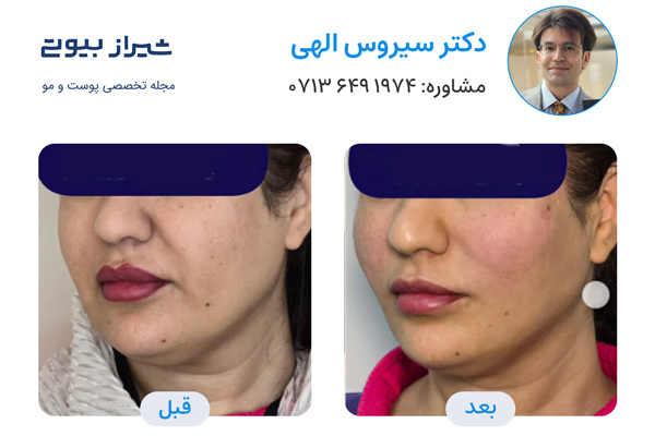 لیفت نخ در شیراز - دکتر سیروس الهی