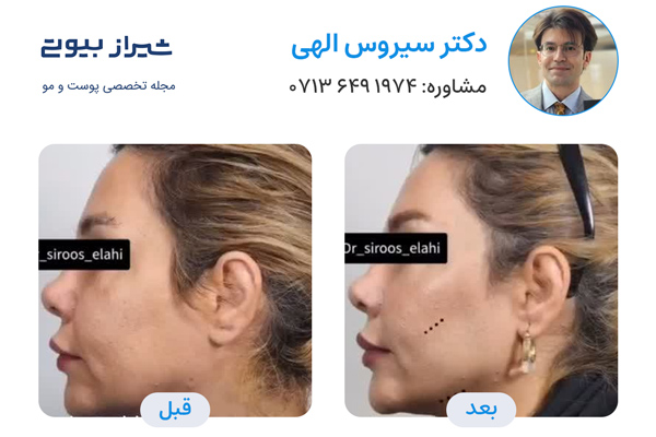 لیفت نخ در شیراز - دکتر سیروس الهی