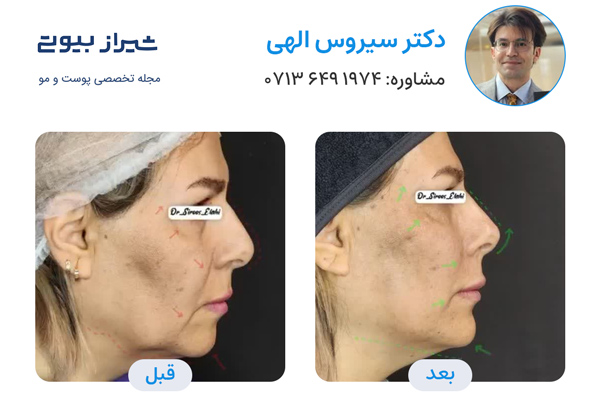 لیفت نخ در شیراز - دکتر سیروس الهی