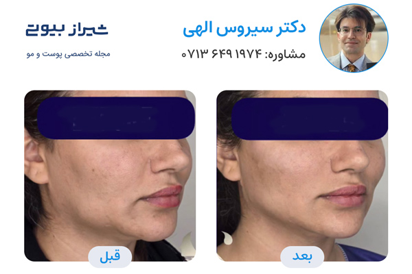 لیفت نخ در شیراز - دکتر سیروس الهی